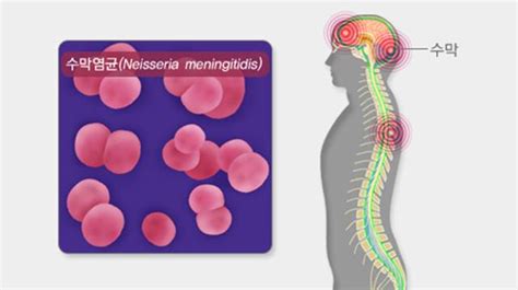 수막구균성 수막염이란 어떤 증상을 보일까 사회 기사 더팩트
