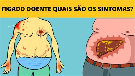 FIGADO DOENTE QUAIS SÃO OS SINTOMAS E COMO TRATAR YouTube