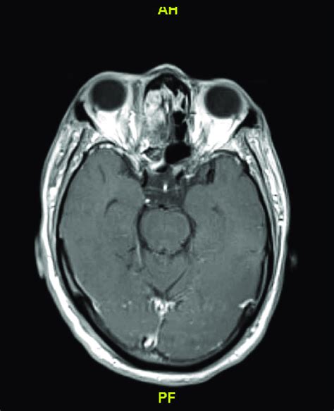 Mri With Contrast Week 5 Persistent Right Ethmoid Sinusitis Fairly