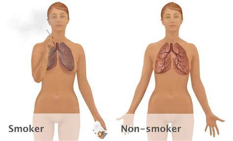 Lungs Of Smoker Vs Non Smoker Poster Print By Gwen Shockeyscience Source 24 X 18