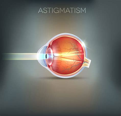 Lasik Surgery Anaheim Eye Institute