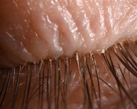 Eyelash Mites Symptoms Causes And Treatment Smartbuyglasses Uk