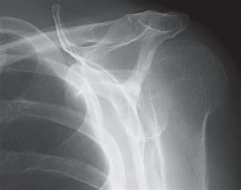 Posterior Shoulder Dislocation Radiology Key