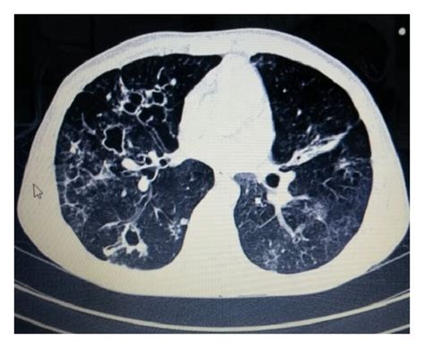 A Chest Radiograph Showing Extensive Multifocal Consolidation And