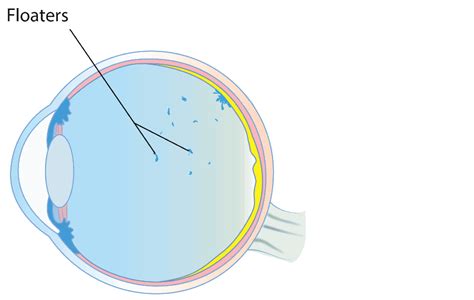 Floaters, Retinal Tears and Retinal Detachment - Chelvin Sng Eye Center ...