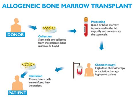 Bone Marrow Transplant Procedure