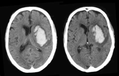 Basal Ganglia Hemorrhage