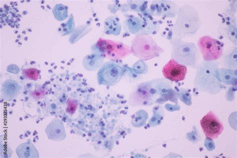 Trichomonas In Pap Smear On White Background View In Microscopicmedical Backgroundcytology And