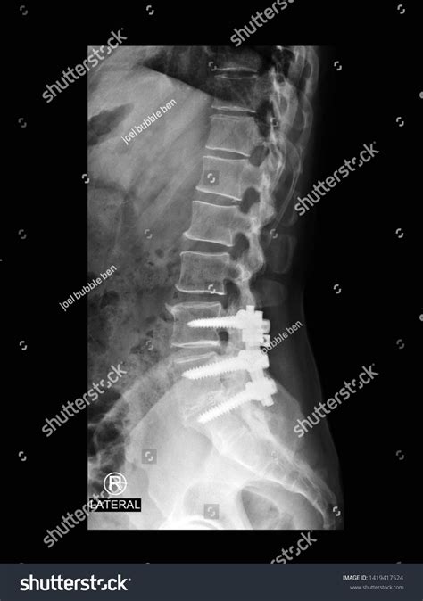 Laminectomy X Ray