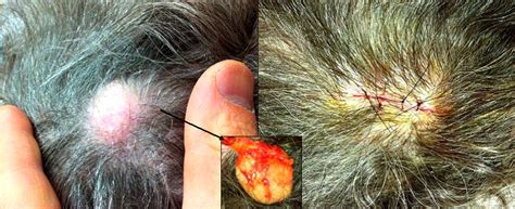 Sebaceous Cyst Scalp