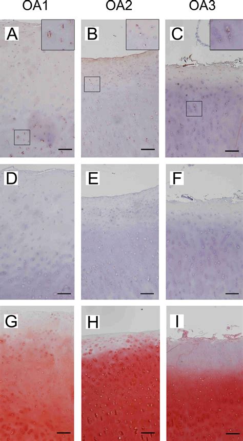 Immunohistochemical Detection Of Htra1 Generated Aggrecan Neoepitope In