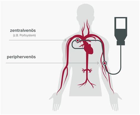 Parenterale Ernährung Zufuhr direkt in Vene