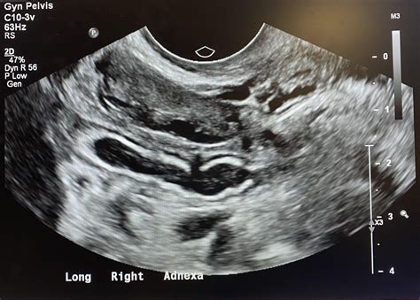 Appendicitis seen on transvaginal ultrasound : r/Radiology