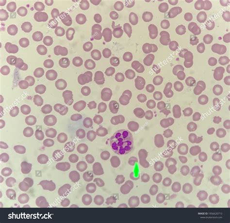 Peripheral Blood Smear Hypersegmented Neutrophil Seen Stock Photo 1956620713 | Shutterstock