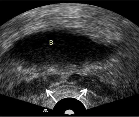 Transrectal Ultrasound Showing Normal Seminal Vesicles Arrows Download Scientific Diagram