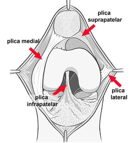 Plica Sinovial Sintomas Tratamento E Cirurgia Instituto Trata