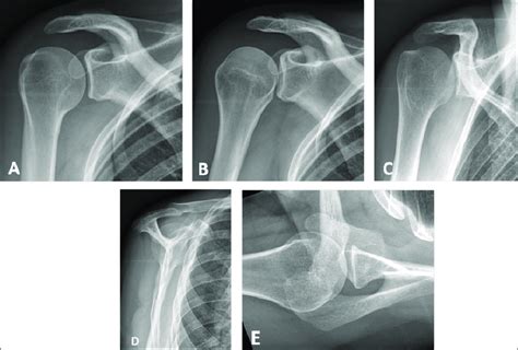 Conventional Radiographs Of The Shoulder A Anteroposterior AP View