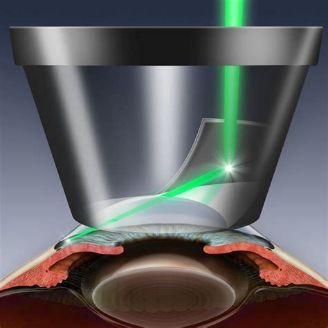 Glaucoma surgery image downloads for patient education