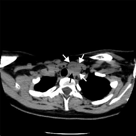 Figure From A Case Report Of A Giant Parathyroid Adenoma Presenting