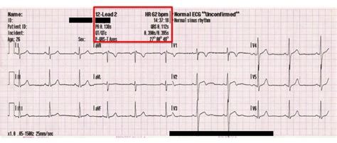 Ecg Interpretation Of Arrhythmias TUSOM Pharmwiki 42 OFF