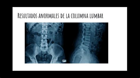 Radiograf A De Columna Lumbar Youtube