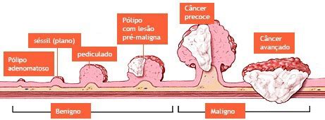 Como É O Câncer No Reto - Anatomia Do Cancer Retal Câncer Colorretal | Aparelho Digestivo Do