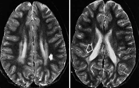 Periventricular Leukomalacia