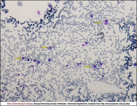 Acute Megakaryoblastic Leukaemia Cell Atlas Of Haematological Cytology