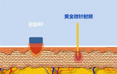 抗衰选热玛吉还是黄金微针？看老司机全面解读！凤凰网