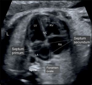 Fetal echo: Simplified 4 chamber view – SujyotHeartClinic