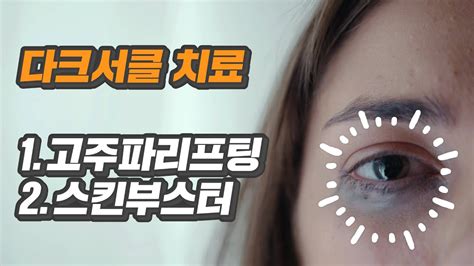 다크서클치료 눈밑지방제거보다 고주파리프팅 스킨부스터가 효과적입니다 Youtube