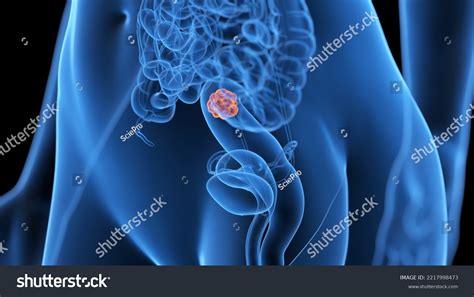 3d Rendered Medical Illustration Colon Tumor Stock Illustration 2217998473 Shutterstock