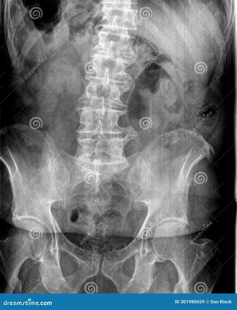 Film X Ray Or Radiograph Of An Adult Lumbar Vertebrae Anterior