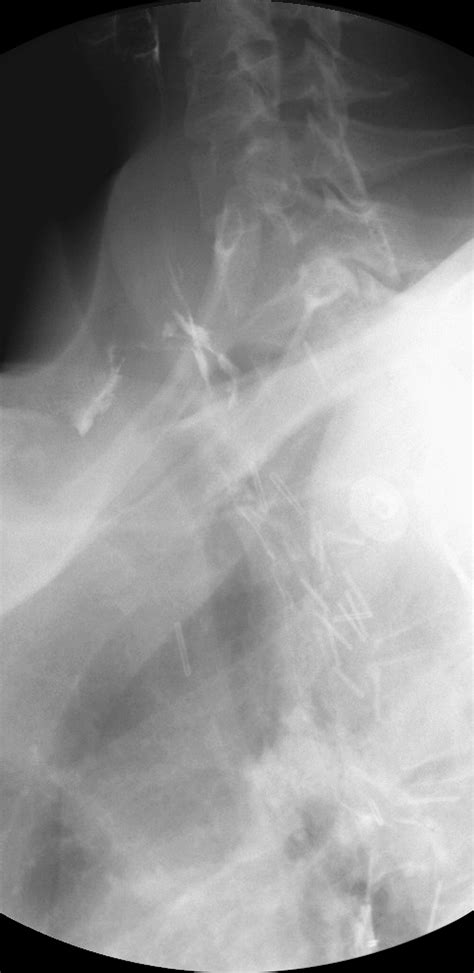 Successful Closure Of A Benign Postsurgical Esophagocutaneous Fistula