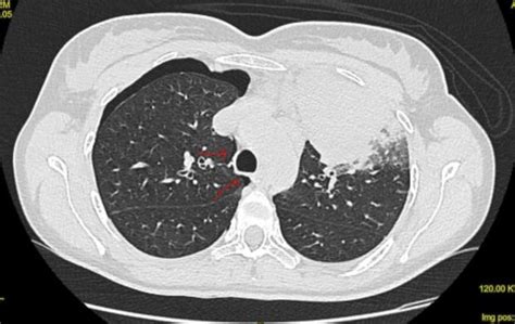 Figure From Pneumomediastinum Following Endobronchial Ultrasound