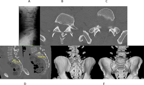 A Lateral Lumbosacral Radiograph Showing Spondylolisthesis At L S