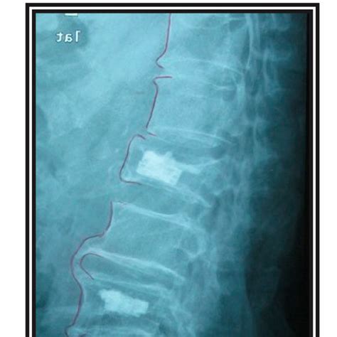 Preoperative Lateral Radiograph Showing Osteoporotic Vertebral