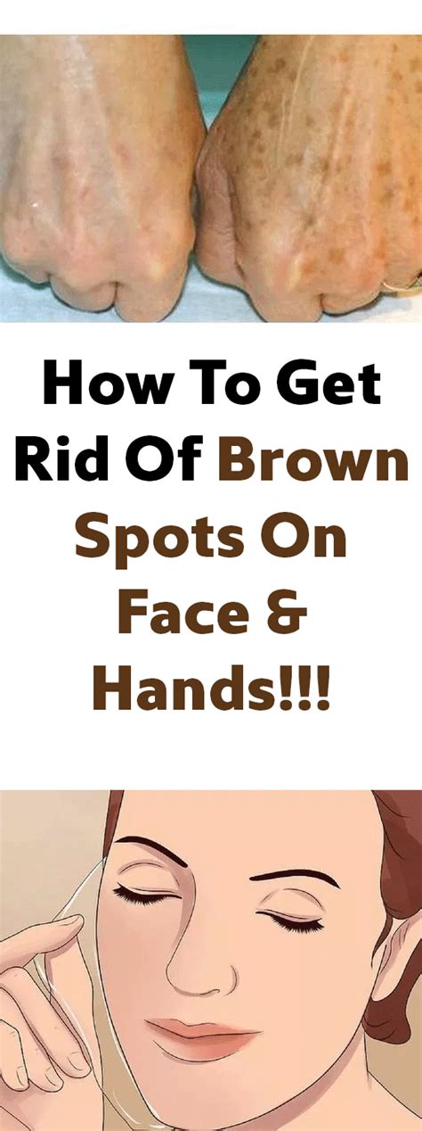 How To Get Rid Of Brown Spots On Face And Hands Brown Spots On Face Brown Spots On Hands