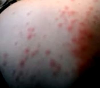 Amoxicillin Rash - Pictures, Treatment, Symptoms, Causes | Health Momma