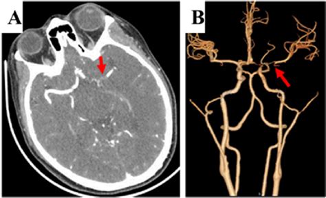 Brain CT Angiography On Admission A Thin Slice Raw Images Of CTA