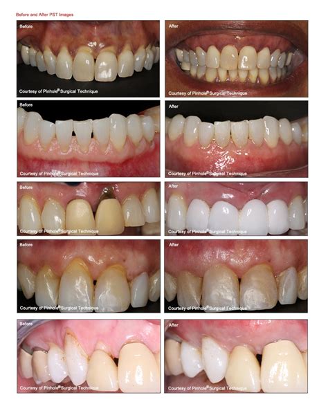 Pinhole Surgical Technique Periodontal Procedures