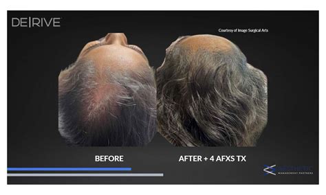 DE|RIVE Hair Restoration | NW Calgary | Fresh Laser Skin Studio