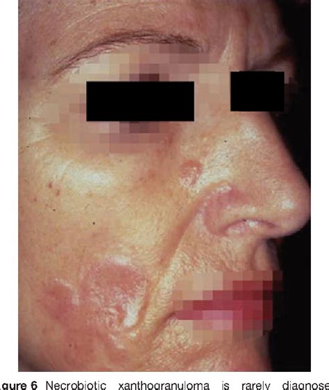 Sarcoidosis Of The Skin A Dermatological Puzzle Important