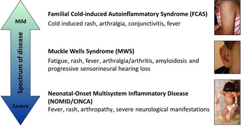 Canakinumab In Patients With Cryopyrin Associated Periodic Syndrome An