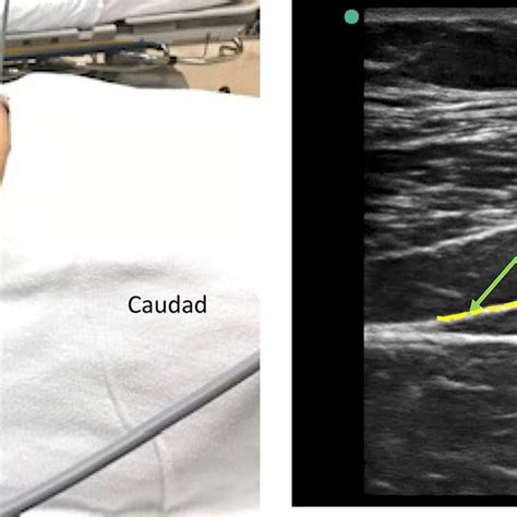 Subcostal Transversus Abdominis Plane Tap Block The Left Image Shows