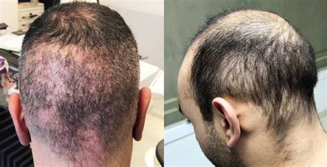 Is It Worth Choosing Turkey Over Singapore For A Fue Hair Transplant