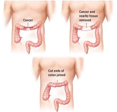 India Surgery Colon Cancer,Cost Colon Cancer Treatment,Colon Surgery