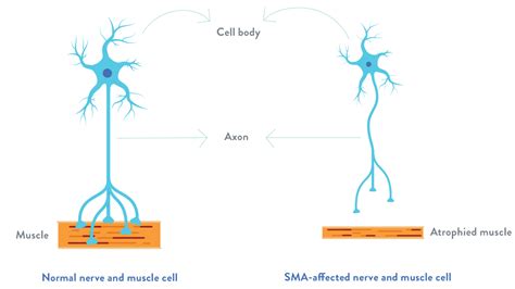 What is SMA (Spinal Muscular Atrophy)? | SMN1 & SMN2 Genes