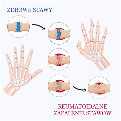 Reumatoidalne zapalenie stawów objawy dieta leczenie