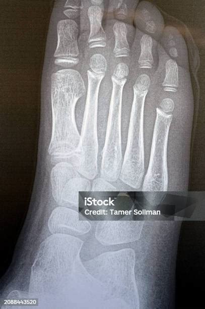 Plain X Ray Of The Right Foot Of A 9 Years Old Child Shows Normal Pediatric Bone Xray Study With ...